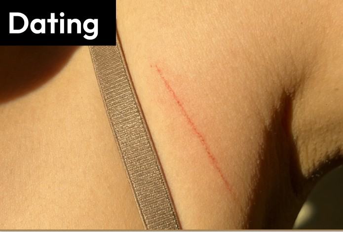 A red mark left on the skin by a bra strap, labeled "Dating".