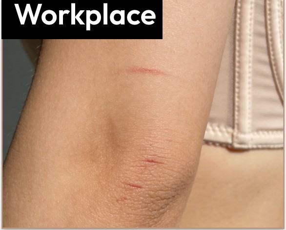 Red marks pressed into the skin of an arm by structured underwear, labeled "Workplace".